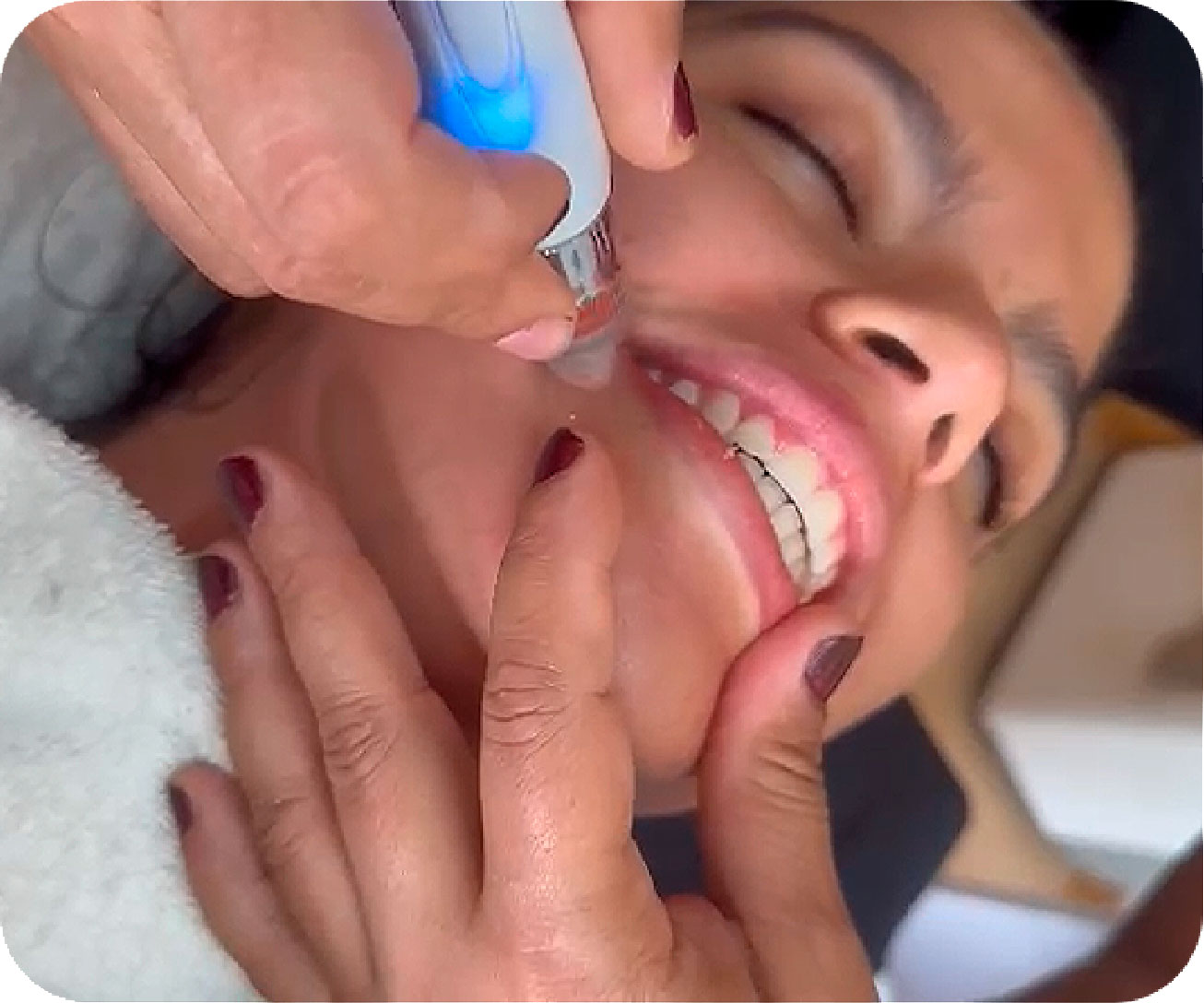 MICRONEEDLING CON DERMAPEN