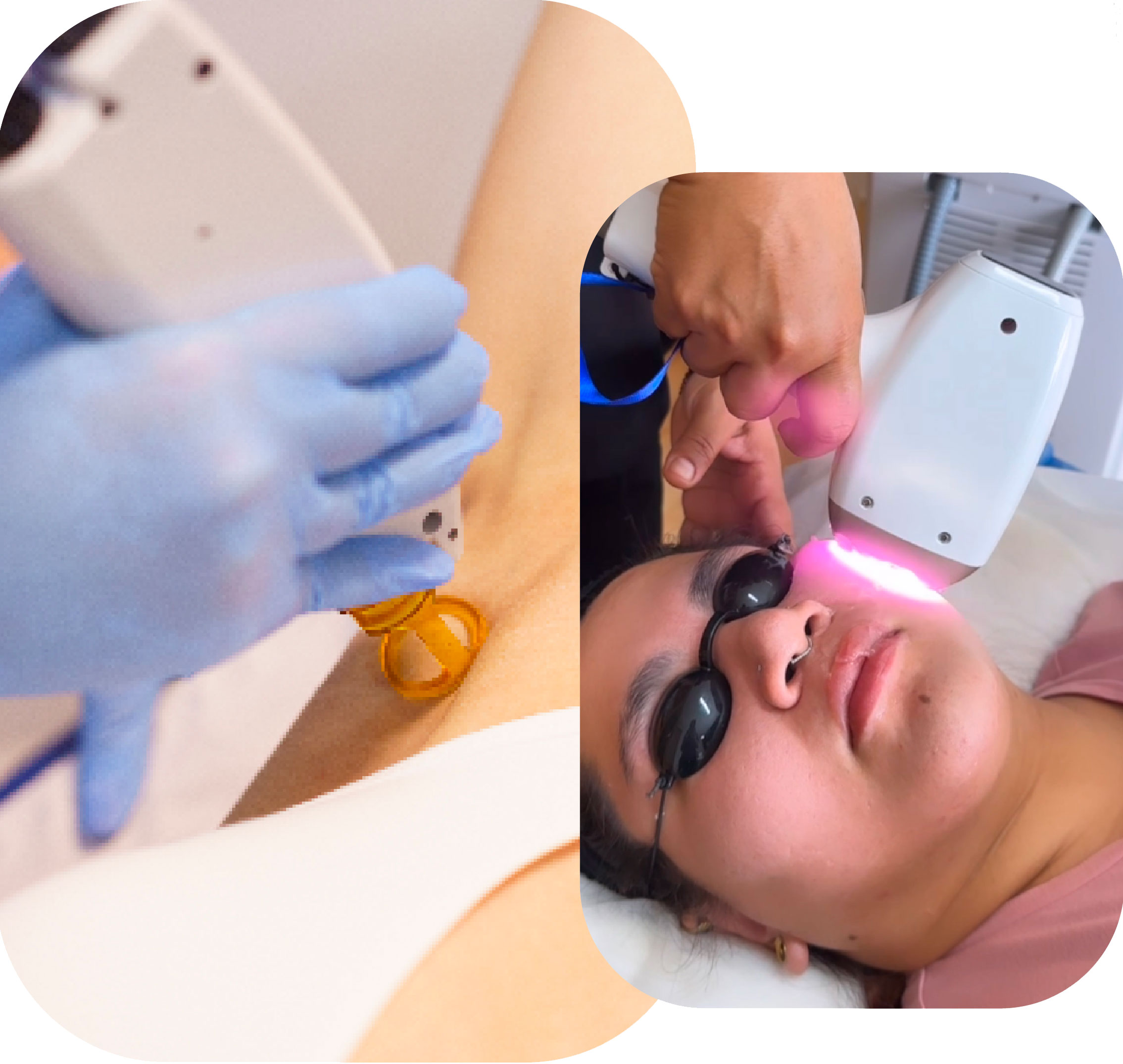 DEPILACION LASER FEMENINA