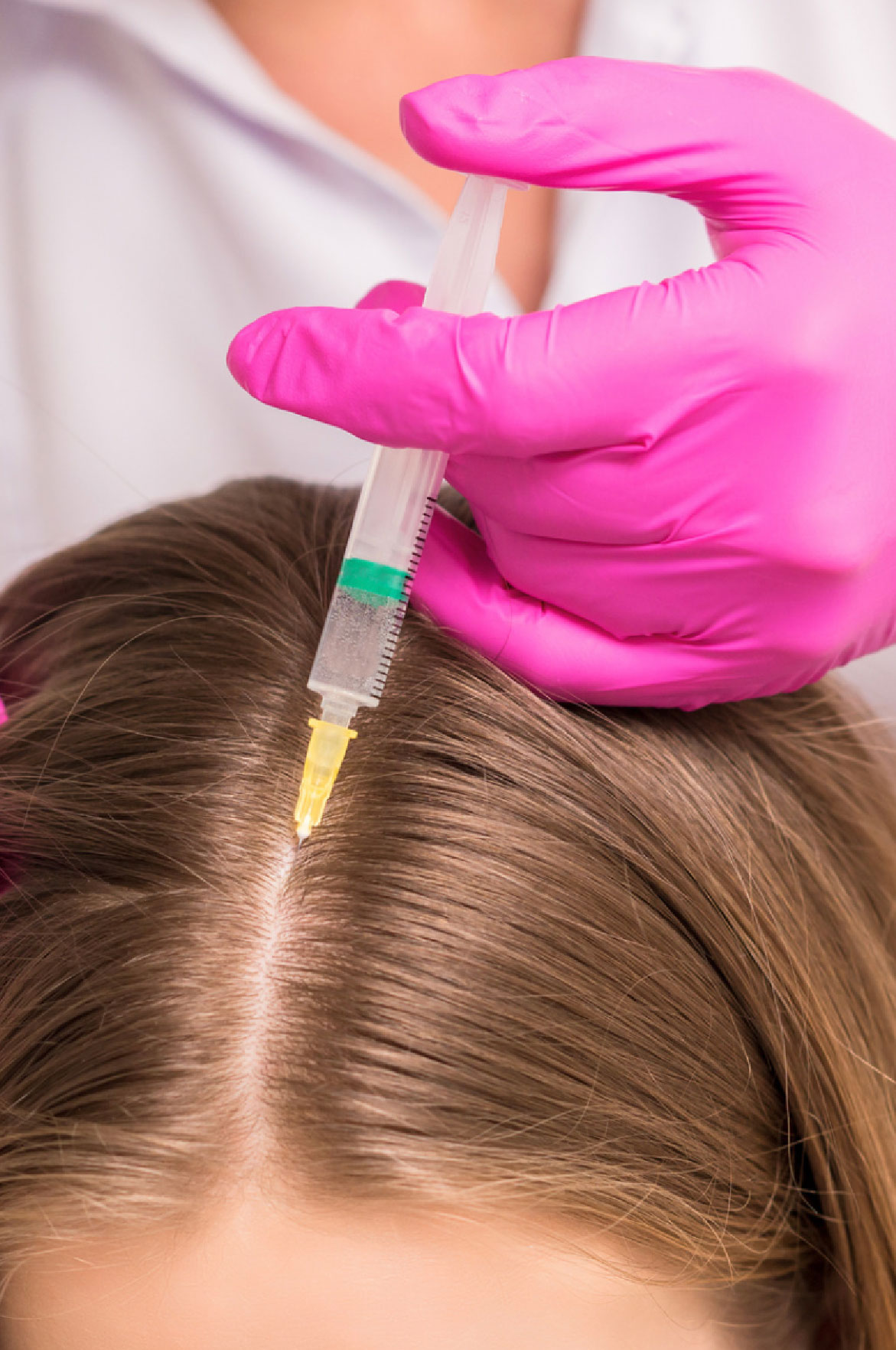 MICRONEEDLING CAPILAR