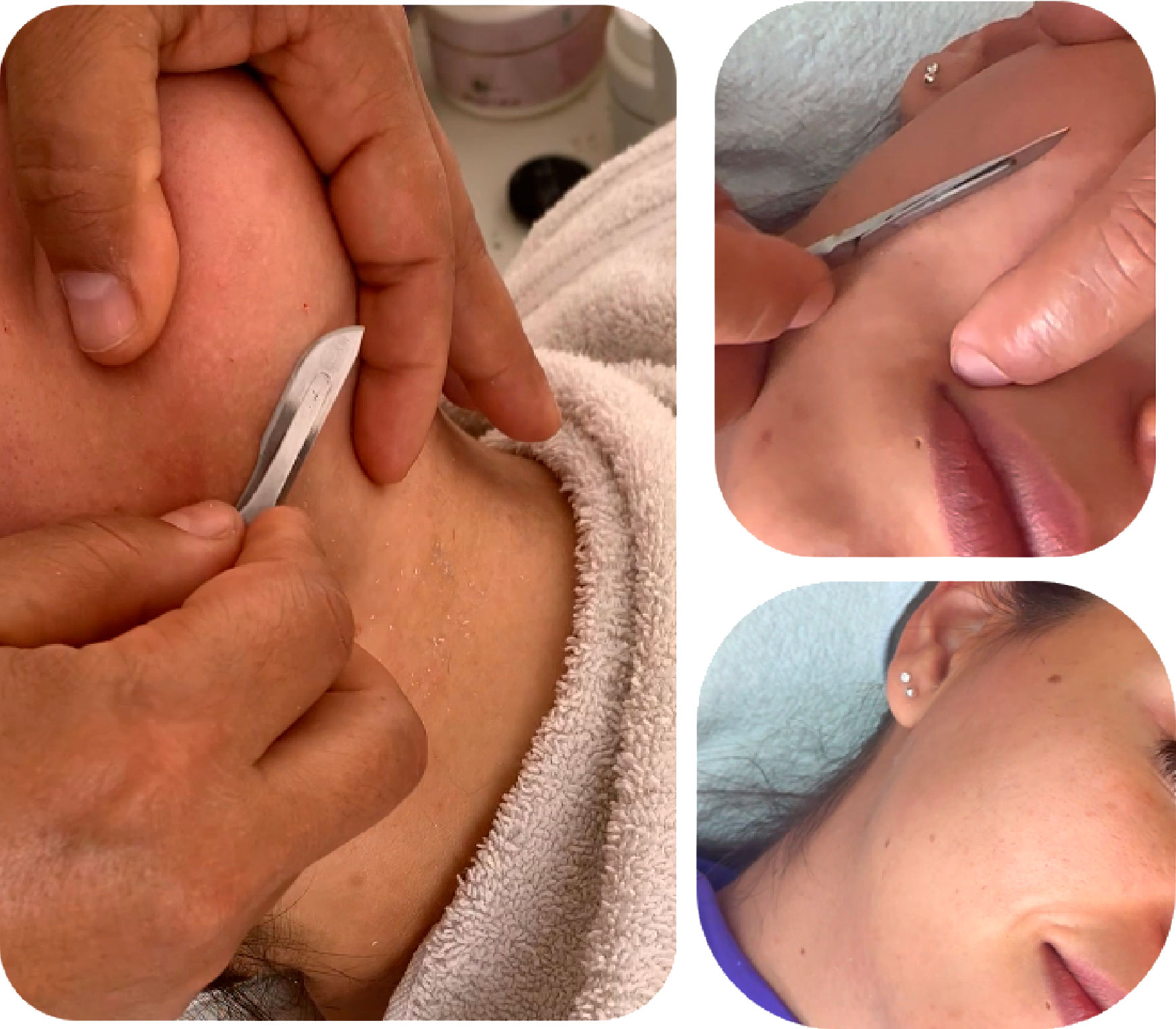 DERMAPLANING