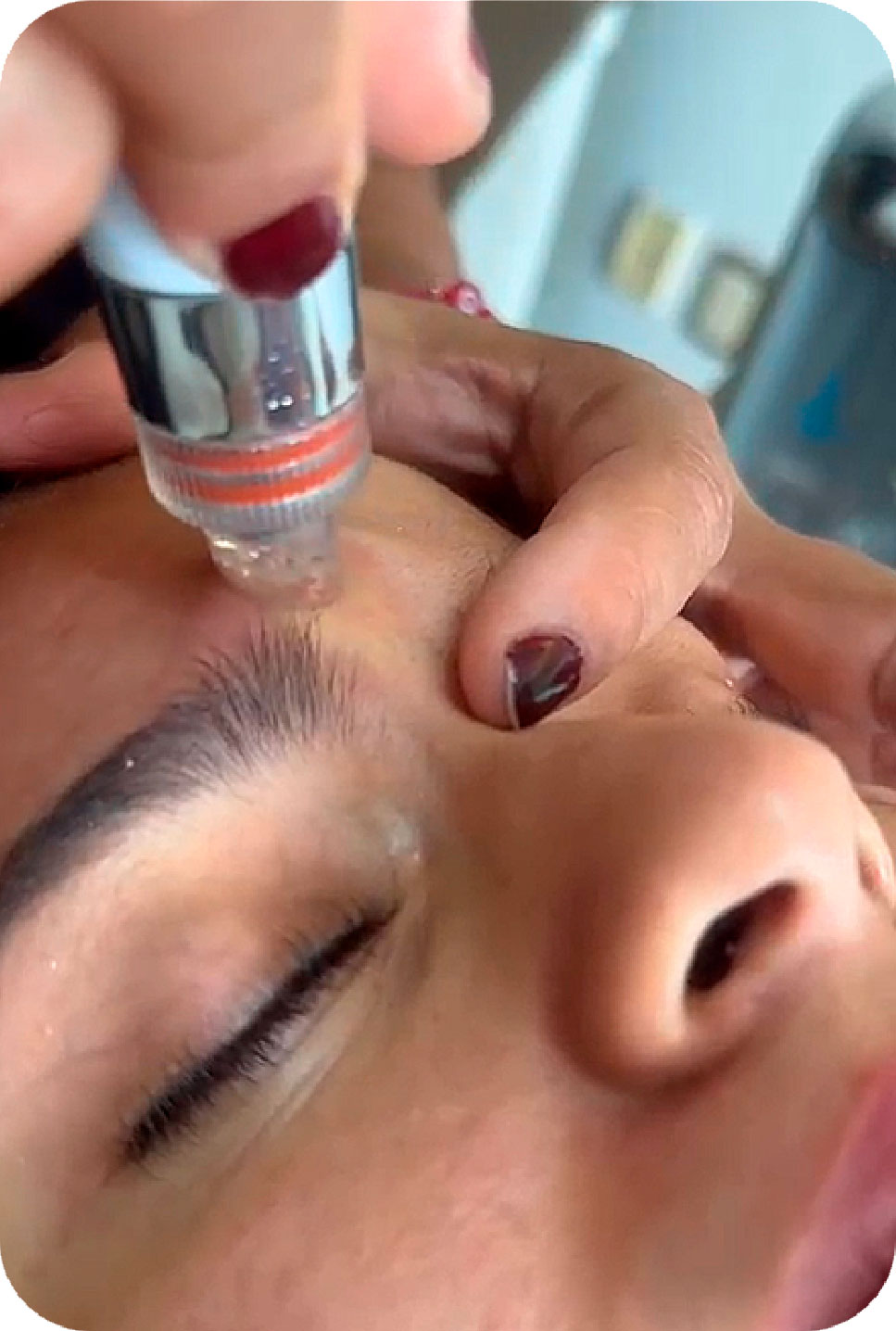 HIDRAFACIAL