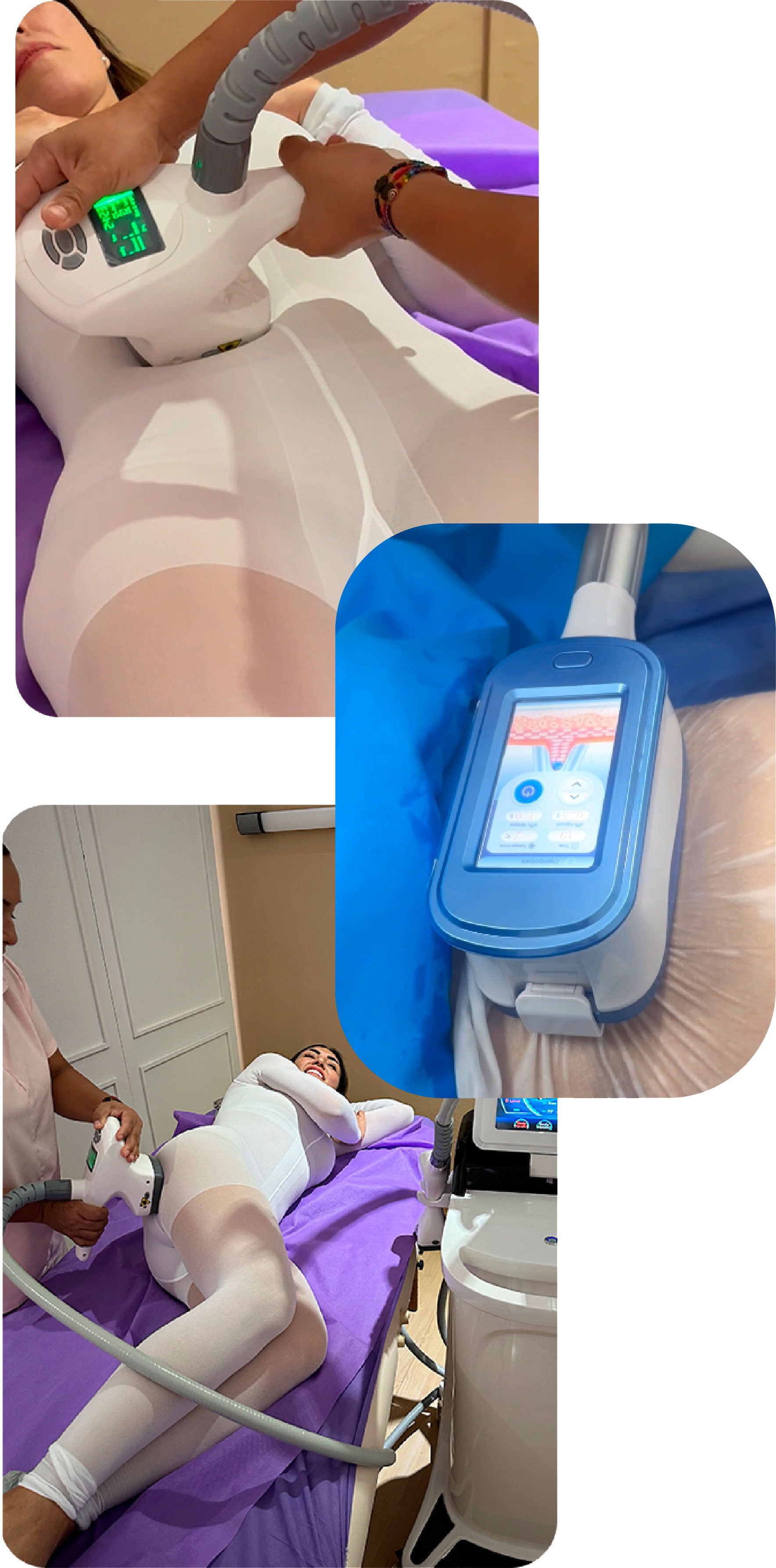 CRIOLIPOLISIS